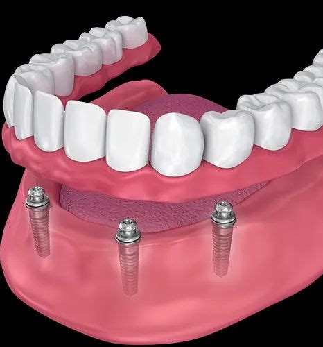 Metallic Non Surgical Dental Implant Surgery Service For Replacement