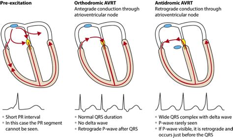 Atrial Fibrillation in WPW Syndrome - The Original Kings of County