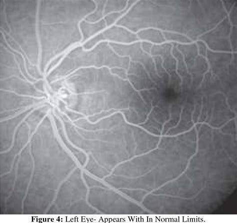 Figure 1 From A Case Report Of Adult Vitelliform Macular Dystrophy Semantic Scholar