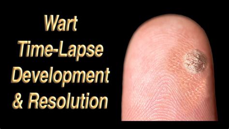 Wart Development And Resolution Time Lapse Youtube