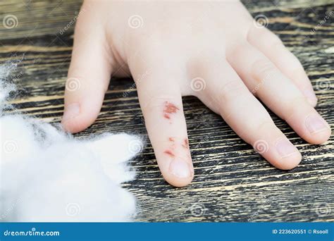 A small injury stock image. Image of abrasion, injury - 223620551