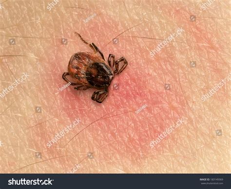 Tick Head Sticking Human Skin Red Stock Photo 183149369 Shutterstock