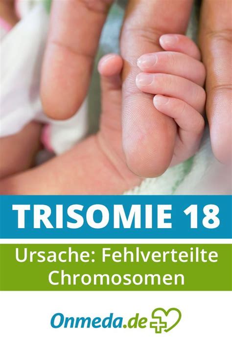 Trisomie 18 Edwards Syndrom Medizin Entwicklungspsychologie Krankheit