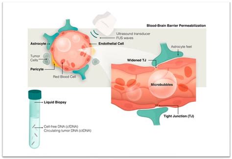 Cancers Free Full Text Adding Value To Liquid Biopsy For Brain