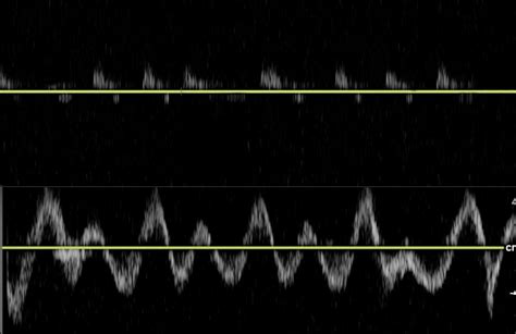 Here Is A Comparisonof Invasive Vs Non Invasive Hemodynamics Using