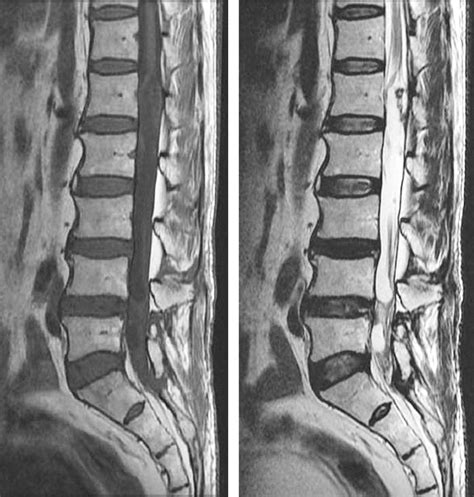 Preoperative T1 Weighted Mri Sagittal A And T2 Weighted Mri Sagittal