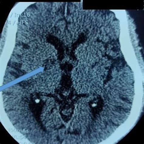 Axial Section Of Brain Ct Scan Without Injection Showing A Right