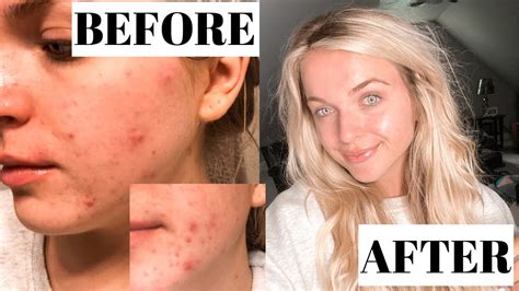 My Acne Journey How I Cleared My Skin And The Products Used Youtube