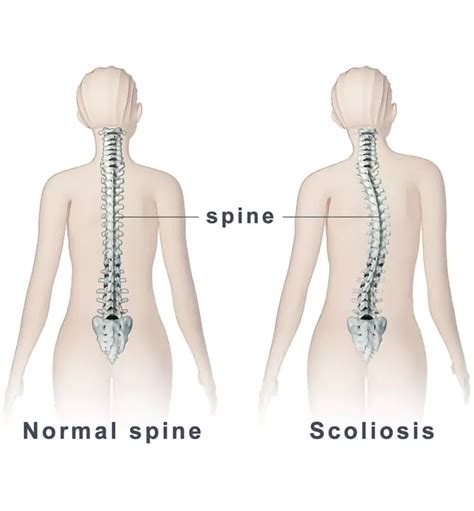 Scoliosis Surgery In India Cost Best Doctor Hospital