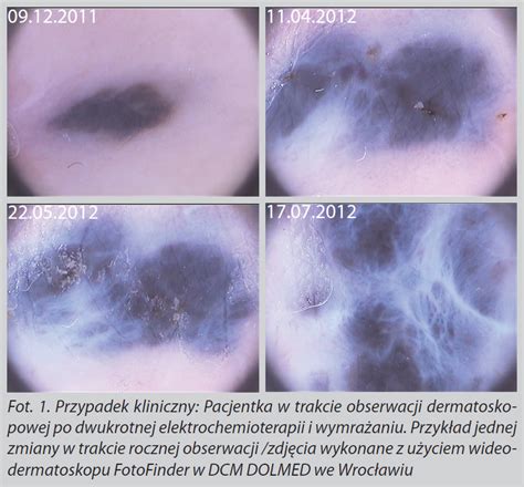 Dermatoskopia Cyfrowa W Praktyce Dermatologa Cx News