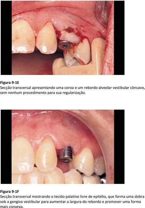 Manipula O De Tecido Mole Ao Redor De Implantes Na Zona Est Tica Pdf