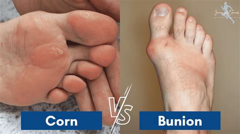 Corn Vs Bunion Bunion Vs Callus Causes Of Big Toe Pain