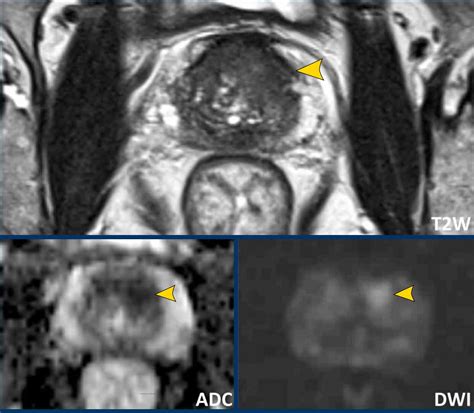 The Radiology Assistant Prostate Cancer Pi Rads V21