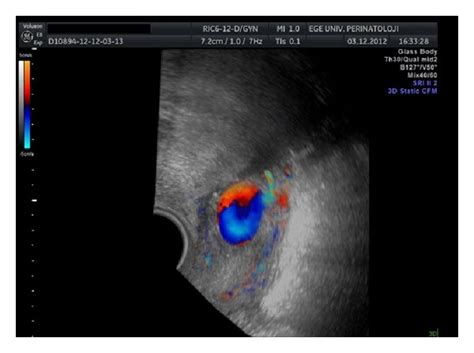 Three Dimensional 3d Sonography Or 3d Power Doppler Mode Showed The