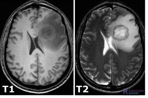 Mri Technique