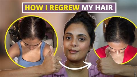 My Hair Loss Journey And How I Am Growing It Back Youtube