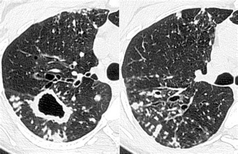 Tree In Bud Pattern At Thin Section CT Of The Lungs Radiologic