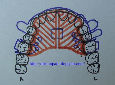 Ortodonti Fkg Unpad Praktikum Desain Alat Ortodonti Lepasan Rahang