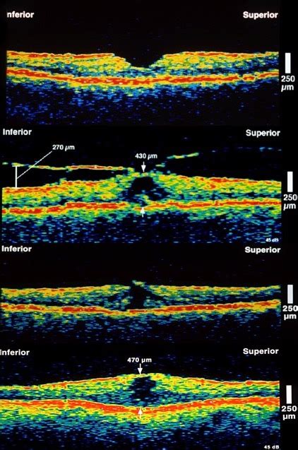 Optical Coherence Tomography Milestones In Retina