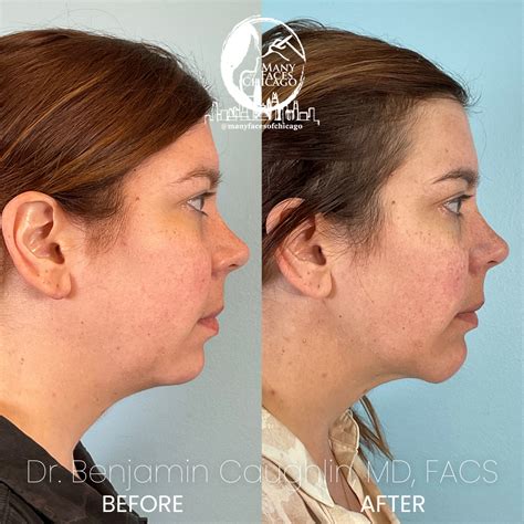 Combination Of Buccal Fat Removal Jawline Sculpting Chin Implant