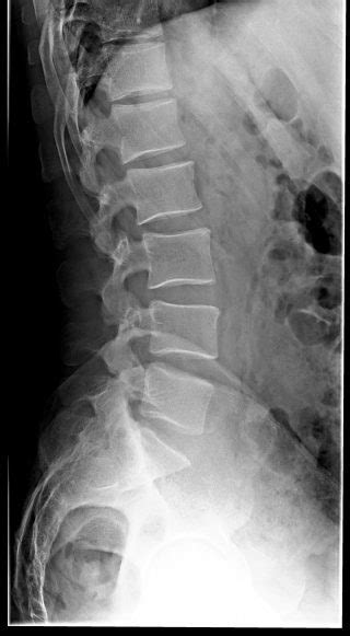 Rx Colonna Lombo Sacrale Radiografie A Domicilio A Torino