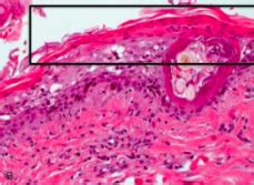 Approach To Pustular Papular Scaling Crusting Skin Disease