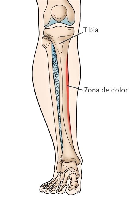 Periostitis Tibial Qu Es Tiene Tratamiento