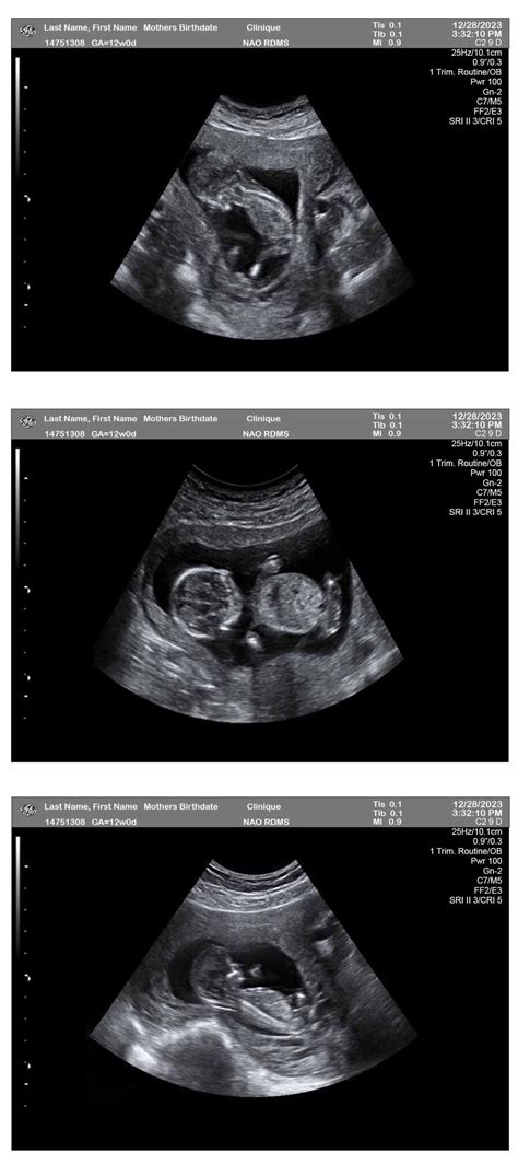 12 Weeks Sonogram Ultrasounds