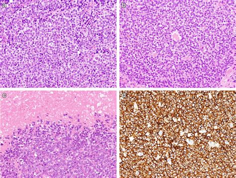 A Ewing Sarcoma A Monomorphous Round Cell Proliferation Organized In A