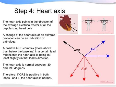 Ecgpedia Ecg Presentation