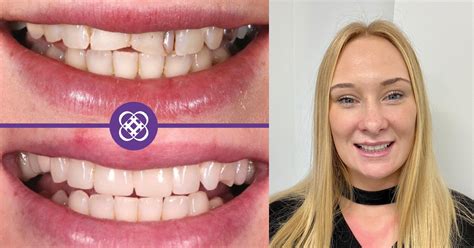 Grace S Story Smile Makeover Dental Beauty Swanley