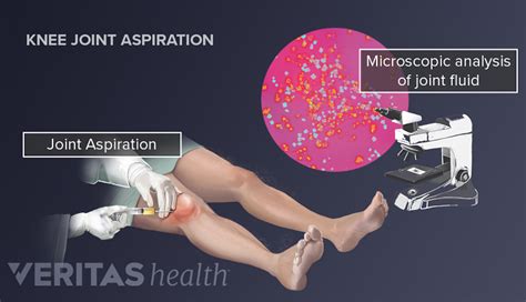 Diagnosis through Synovial Fluid Analysis | Arthritis-health