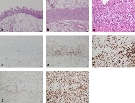 Microscopic features of intestinal myenteric ganglionitis in the small ...