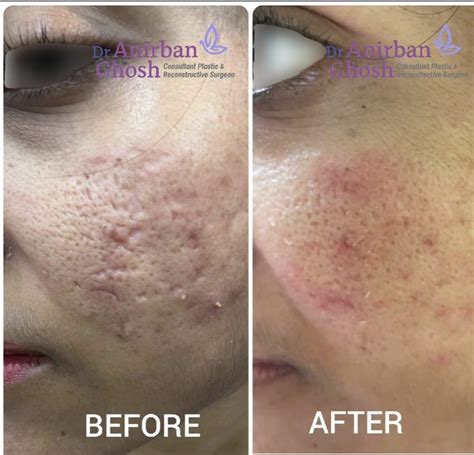 Before After Dr Anirban Ghosh Top Plastic Surgeon In Kolkata