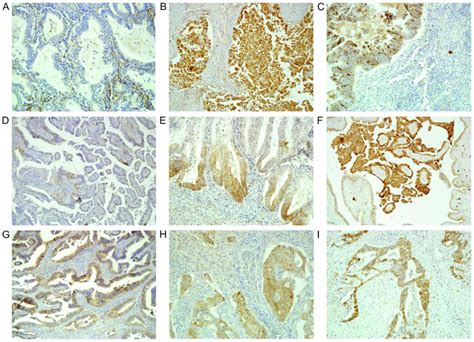 Expression Level Of E N And Pcadherin Proteins In Endometrial Cancer