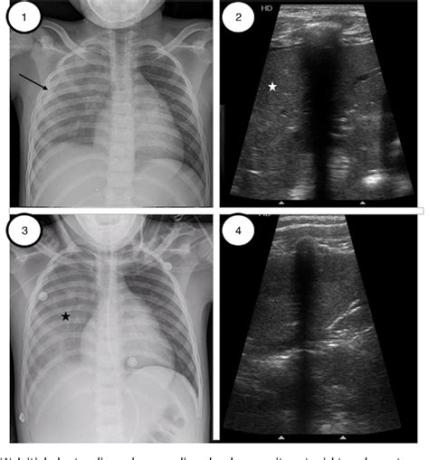 Figure From Ultrasound Guided Recruitment Maneuvers In Pediatric