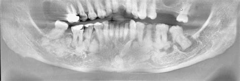 Multifocal Mixed Radiolucent Radiopaque Lesions In An Adult The