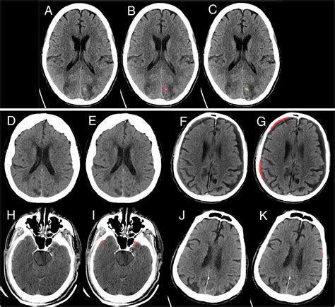 Brain Hemorrhage Scan