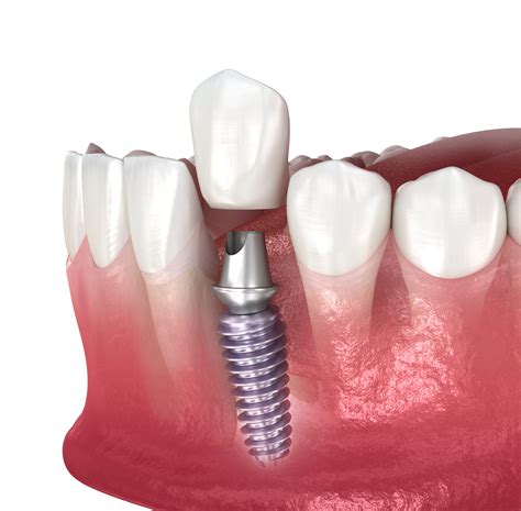 dental implant leeds dental centreleeds dental centre