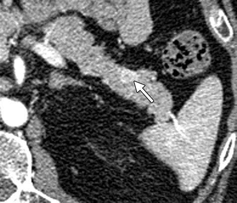 Intraoperative Ultrasonography Of The Pancreas Radiographics