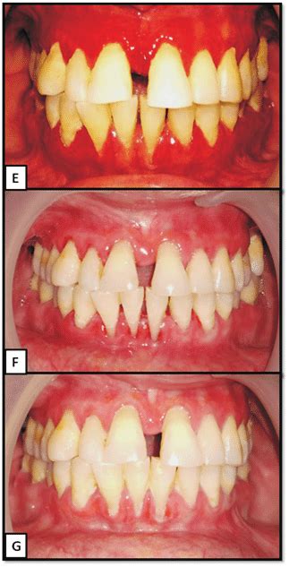 A Preoperative Photographs Showing Attached And Marginal Gingiva