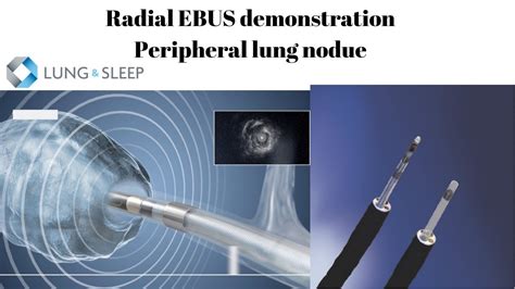 Radial Endobronchial Ultrasound EBUS Bronchoscopy Demonstration Of