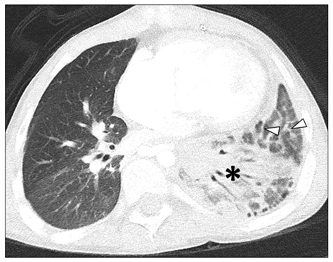 Left Lower Pulmonary Vein