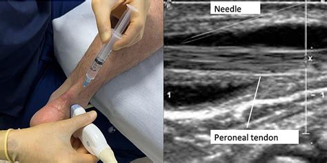 Cortisone Injection For Carpal Tunnel Ankle Tendonitis Steroid