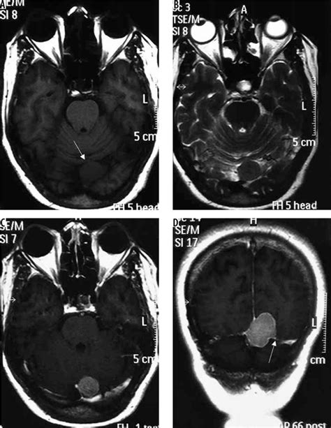 Imaging Spectrum Of Meningiomas A Review Of Uncommon Imaging