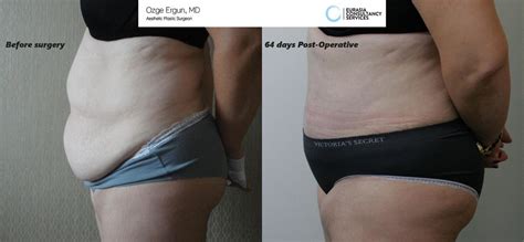 Abdominoplastia Plastic Surgery Before And After Photos