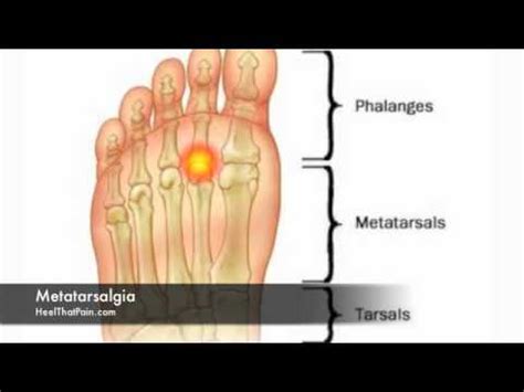 Metatarsalgia Foot Pain Causes, Symptoms, & Treatments - YouTube