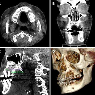 Computed tomography with 3-dimensional reconstruction. A, B: Computed ... 