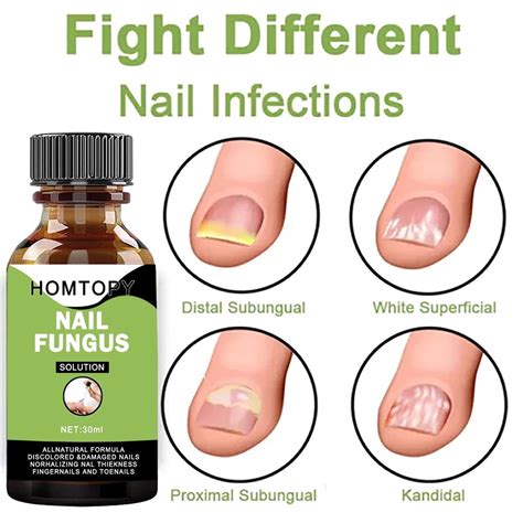 Anti Fungal Treatment Extra Strength Toenail Fungus Fungi Xs Nail