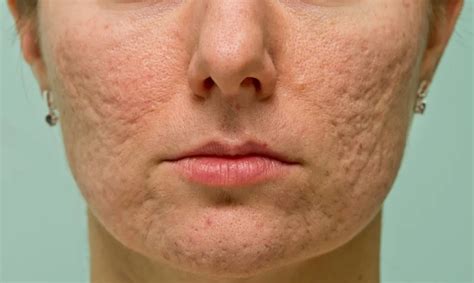 Rolling Acne Scars Causes And Solutions Trusted Aesthetic Clinic